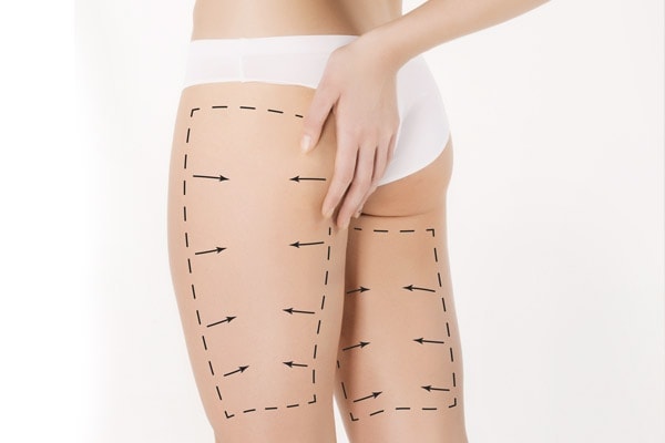 Cirugia Muslos | Dr. César Padilla, Málaga