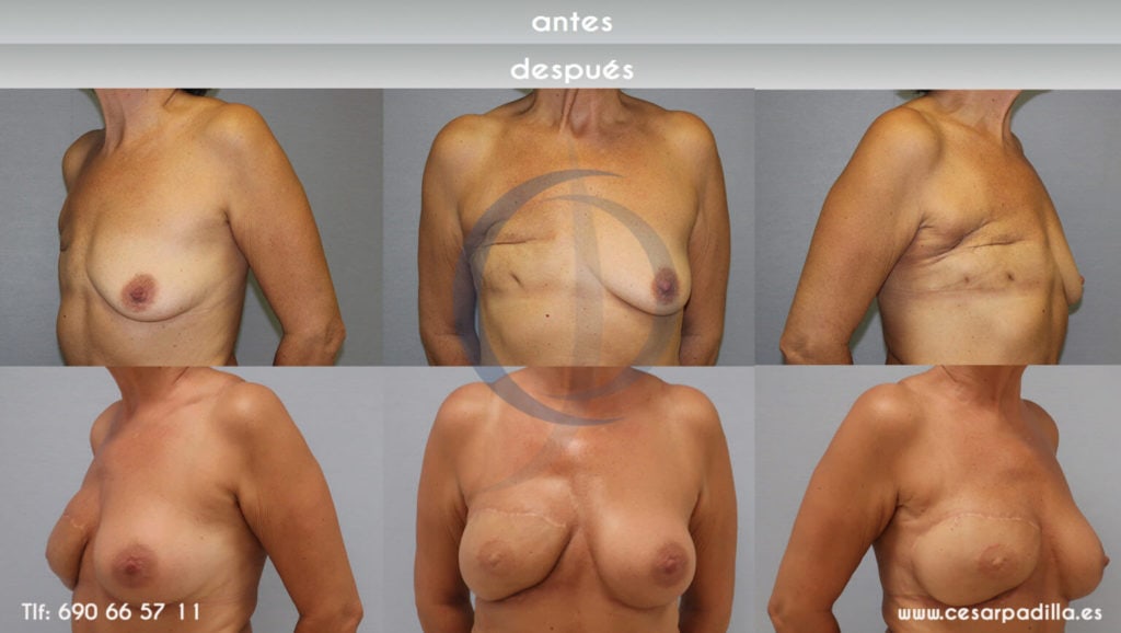 Reconstrucción mamaria después de la mastectomía