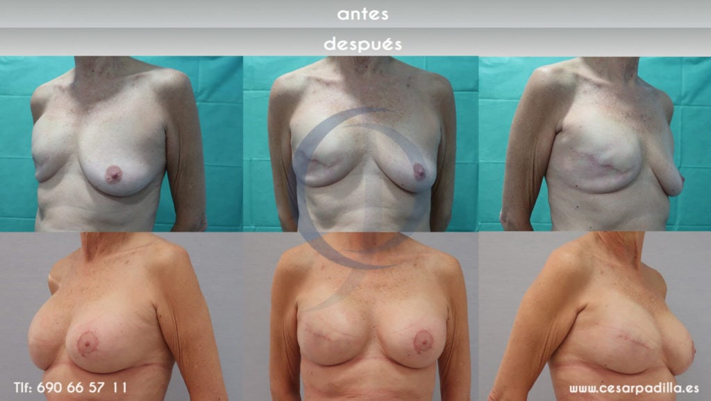 Reconstrucción parcial de un pecho tras la mastectomía