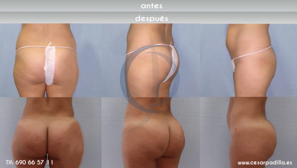 Antes y después de la cirugía Brazilian Butt Lift realizada por el doctor César Padilla