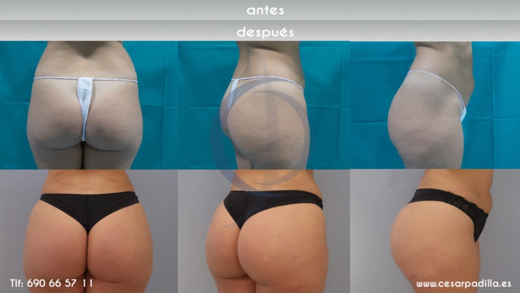 Antes y después de la cirugía Brazilian Butt Lift realizada por el doctor César Padilla