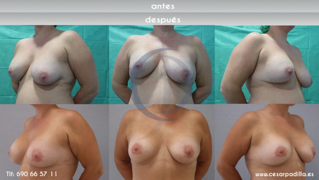 Asimetría mamaria: causas, soluciones y beneficios de la cirugía