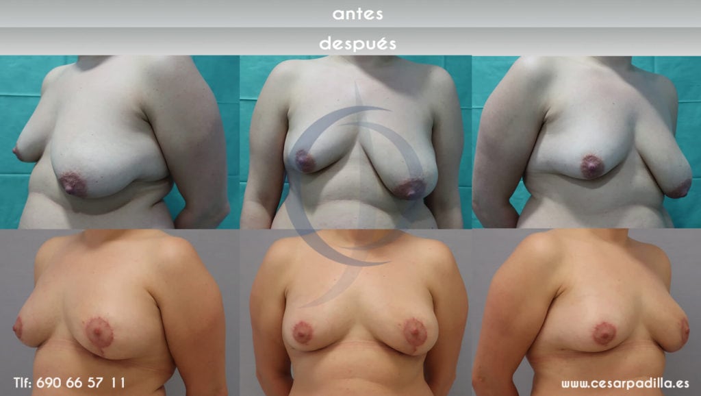 Asimetría mamaria: causas, soluciones y beneficios de la cirugía