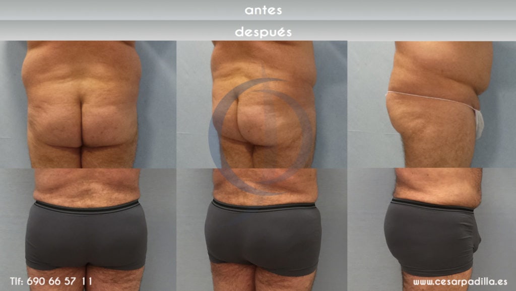 Aumento de glúteos en hombres, fotografía de espaldas, diagonal y de perfil