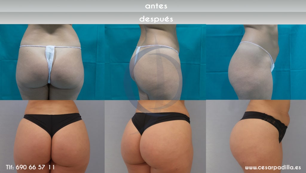 Antes y después del aumento de glúteos, se tienen una fotografía de espaldas, de lado y diagonal