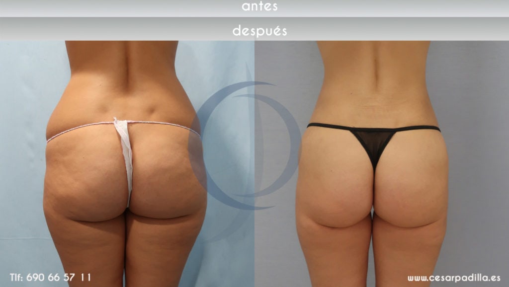 Imagen del antes y después de la lipoescultura: mujer de espaldas, se nota cómo su cuerpo está mejor proporcionado ahora, luce armónico y estético