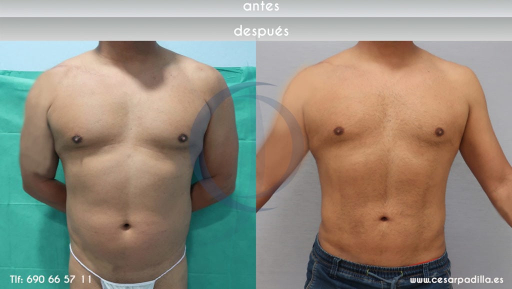 Caso de antes y depués de lipoescultura en hombres en la region abdominal.