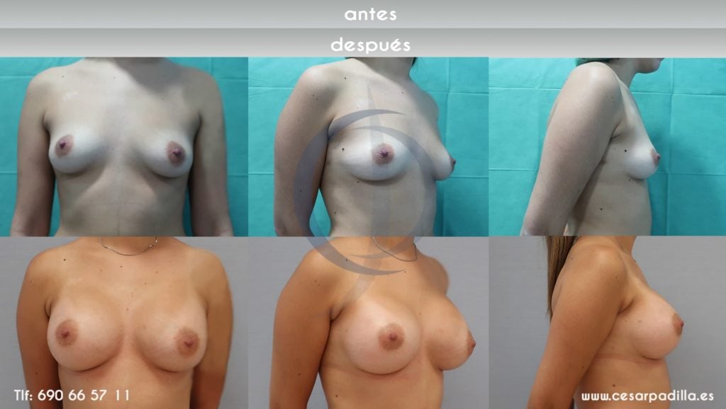 Antes y depués de la cirugía de aumento de pecho, se ve la foto frontal lateral y diagonal de la paciente