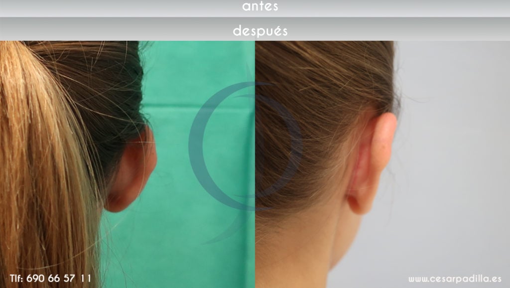 Vista del antes y después de una reducción de orejas
