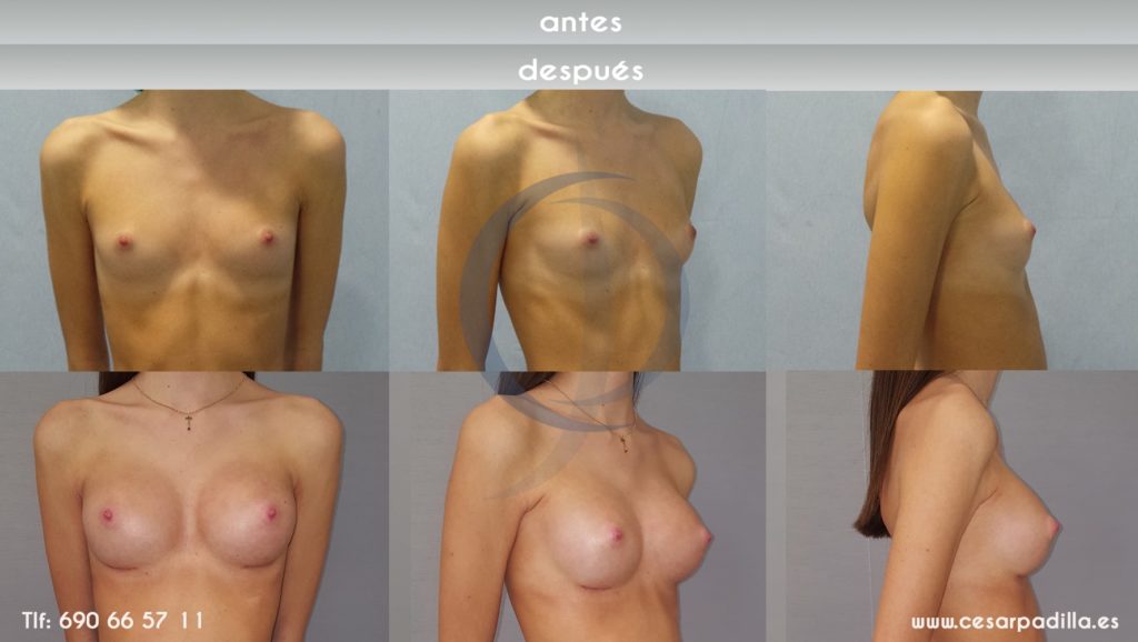 Antes y depués de la cirugía de aumento de pecho, se ve la foto frontal lateral y diagonal de la paciente. En este caso la paciente tenía los pechos muy muy pequeños