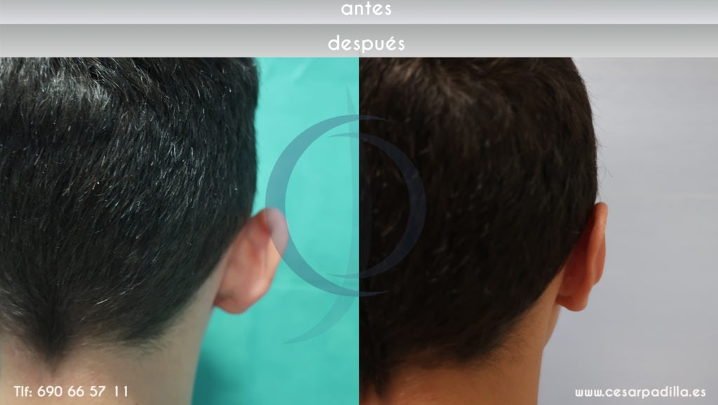 Vista del antes y después de una reducción de orejas en un hombre joven