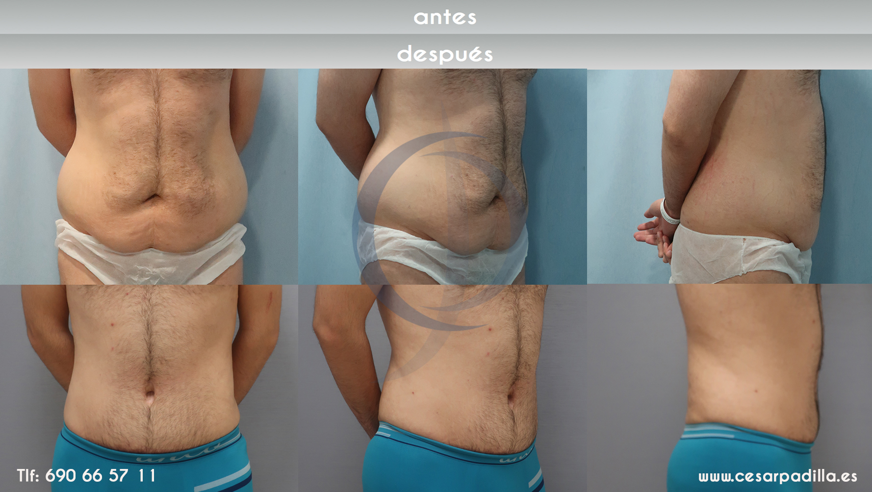 gráfica que muestra el antes y depués de la abdominoplastia en un hombre