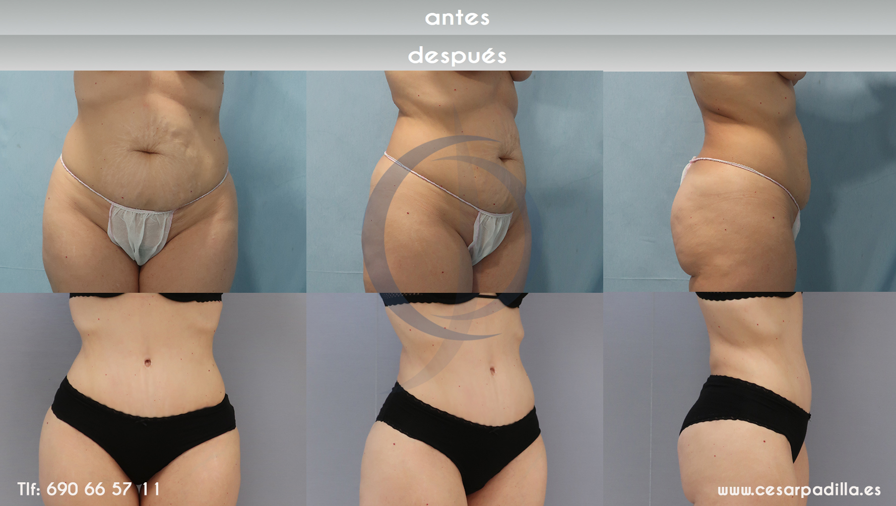 gráfica que muestra el antes y depués de la abdominoplastia en una mujer
