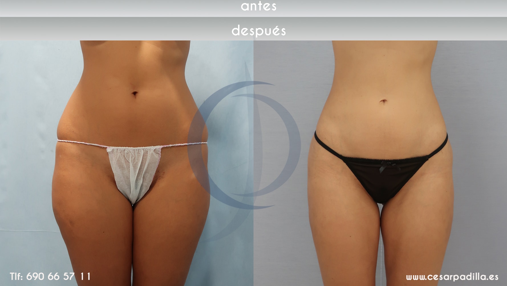 Imagen antes y depués de la liposucción en una mujer