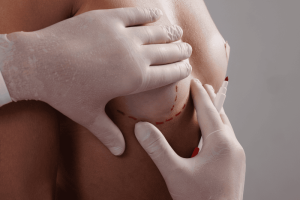 operacion aumento de pecho